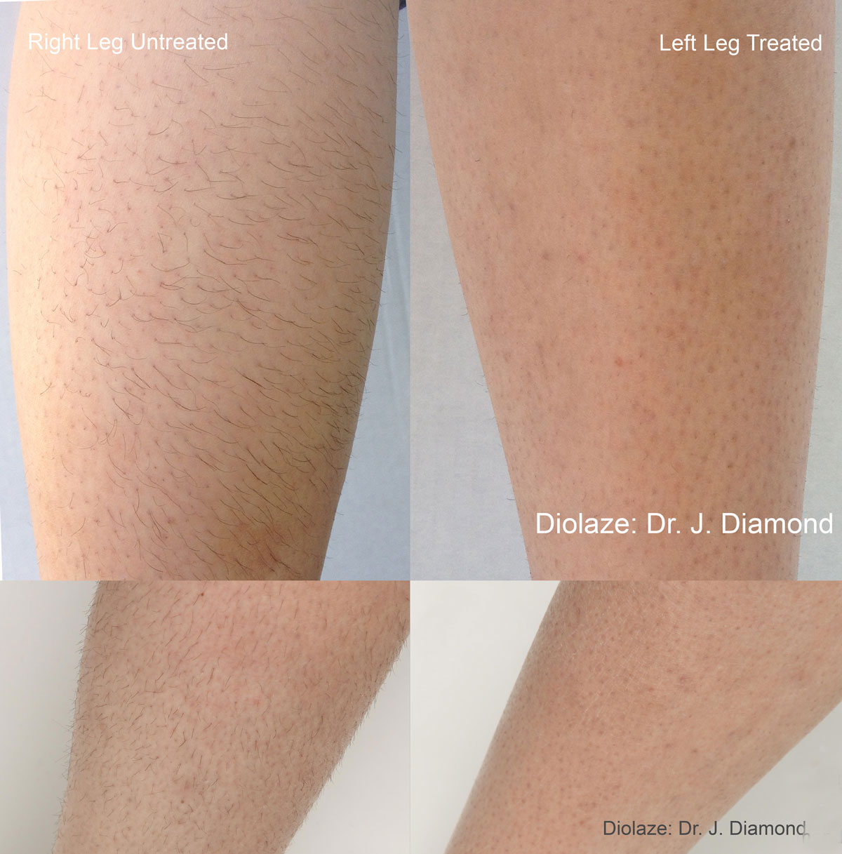 Hair Removal - Health Horizons Usa