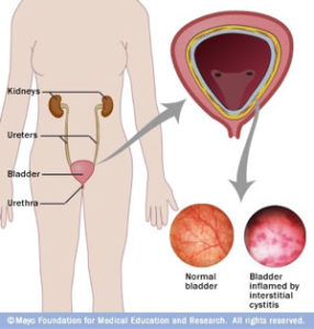 Interstitial Cystitis Health Horizons Usa